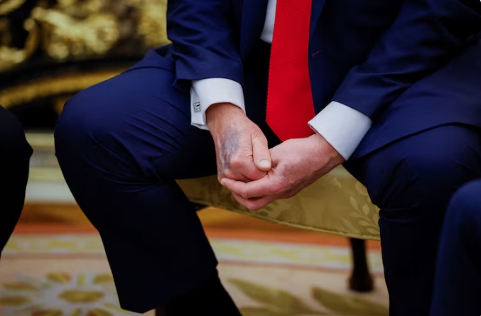 特朗普出现时手背有瘀伤